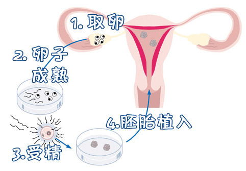 爱心供卵助孕咨询怎么收费